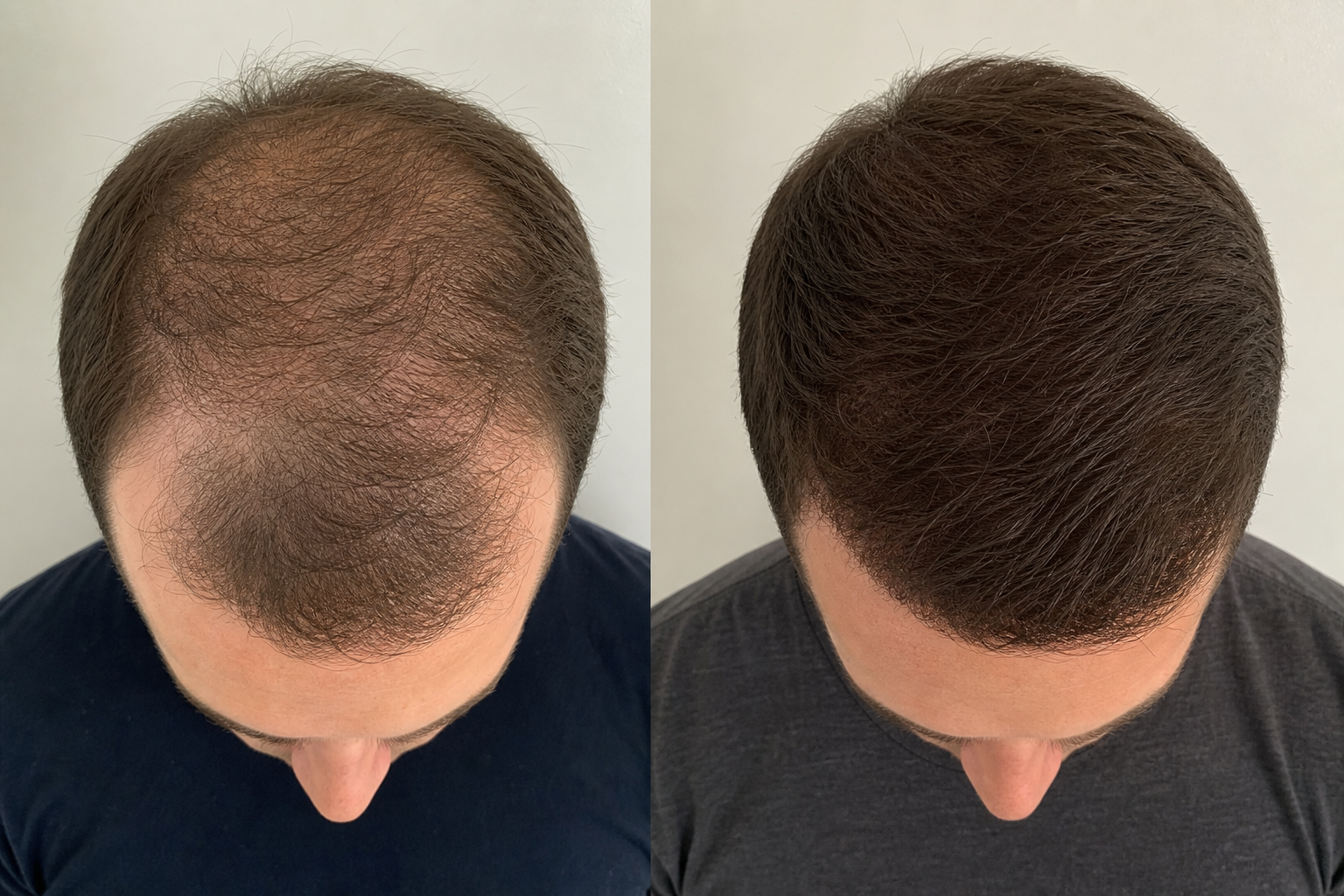 Real male patient: hair growth before and after 6 months of Freeley treatment